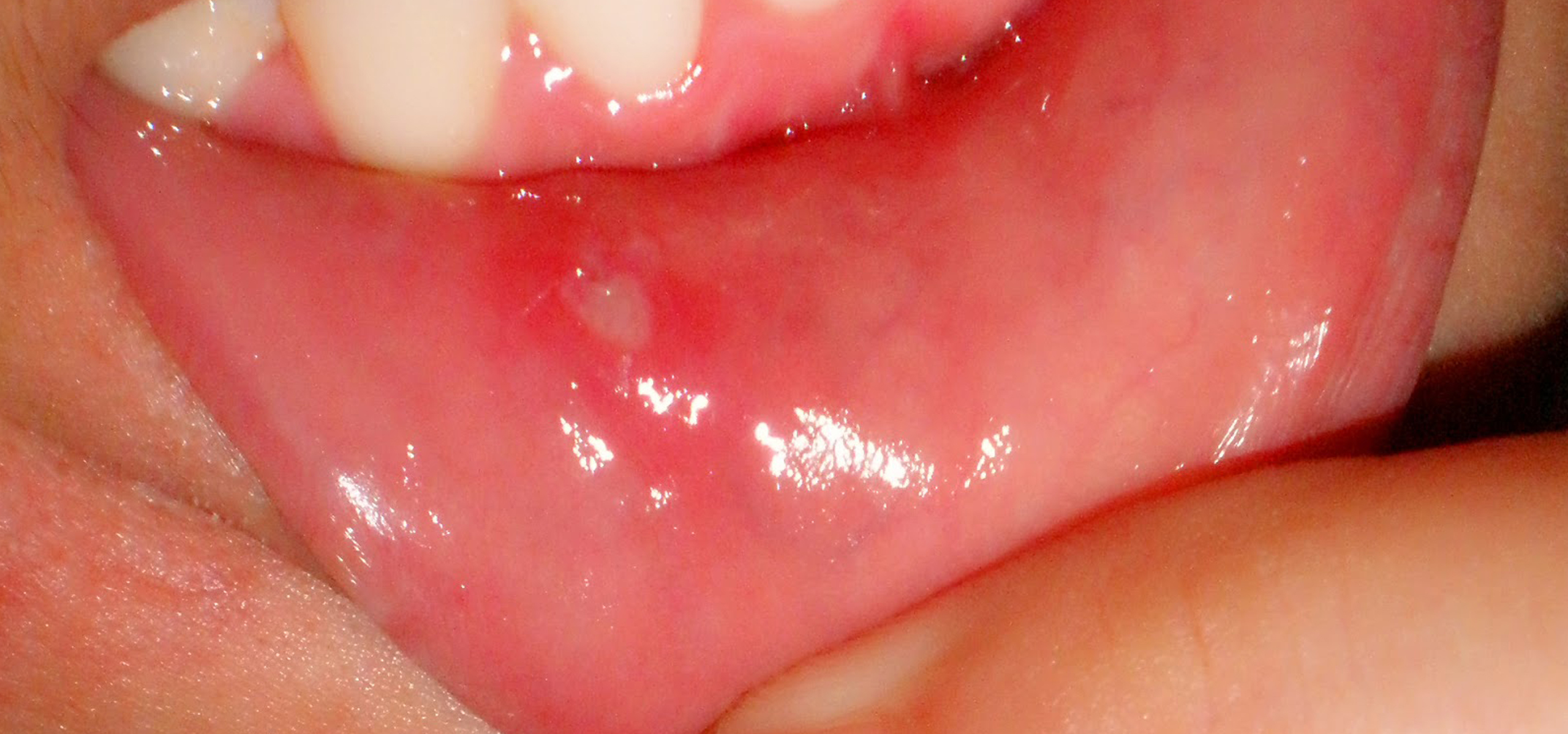 root canal cost in hyderabad 
