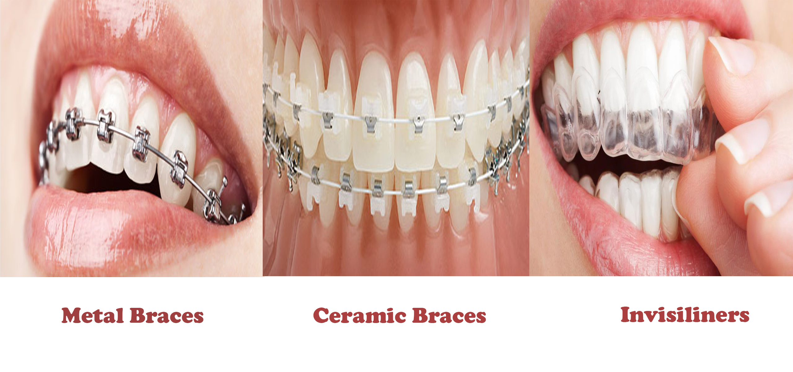 permanent dentures